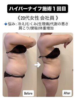 プアマヌ(PUA MANU)/ハイパーナイフ/痩身/肩こり解消