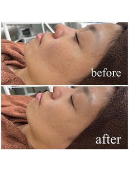 ミラ 中央林間(mira)/小顔　毛穴　ホワイトニング