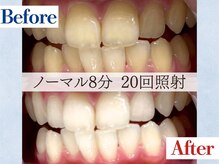 LBSホワイトニング 吉祥寺店/ホワイトニングビフォーアフター