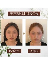ルノア 梅田院(LUNOA)/フェイスライン矯正[梅田/小顔]