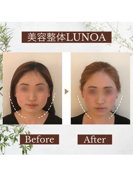 ルノア 梅田院(LUNOA)/フェイスライン矯正[梅田/小顔]