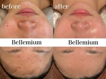 ベレミアム(Bellemium)/ニキビ肌改善☆揺らぎのない肌へ