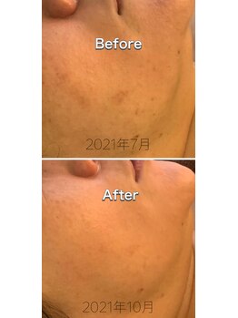 エクシア(ECXIA)/何歳からでも肌は変わる