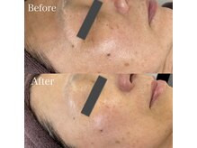 ベルカーラ(Belcarra)/肌質改善美肌フェイシャル