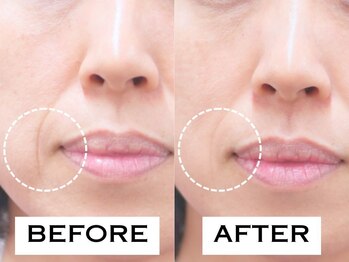 ビハリスト 秋葉原電気街口店/ マリオネットラインが改善！