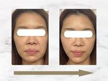 ハリロイヤル トーキョー武蔵小山/美容鍼で顔面構造から変化。