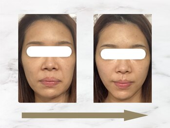 ハリロイヤル トーキョー武蔵小山/美容鍼で顔面構造から変化。