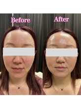 ヨウキ(YOKI)/ハリ感アップ！赤みも改善◎