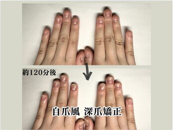 深爪矯正 即日見た目改善
