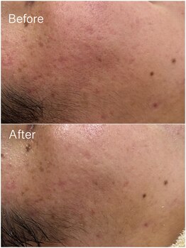 ジョアアンジェ 京橋店(joie ange)/赤み、乾燥ケア