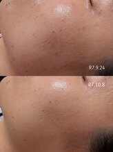 ビアンカーラ(Biancara)/【韓国式ハーブピーリング】