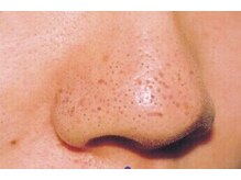 ブルー 四日市店(BLV)/あらゆる毛穴のお悩みに★