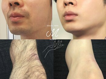 ミシェリ(MCHERI)の写真/【メンズに特化した脱毛サロン】今やメンズ脱毛は身だしなみ！清潔感あるお肌で爆モテに！脱毛デビューに◎