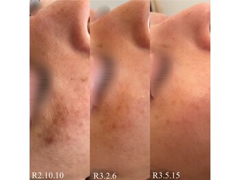 グレーシス(Graces)/シミ/シワ改善