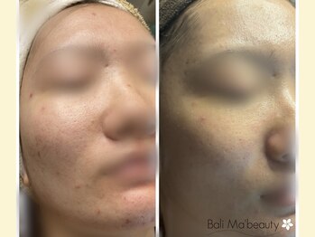 バリマ ビューティー(Bali Ma'beauty)/本格的ニキビケアもサポート◎