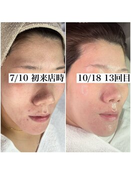 レイ(Rey)/感動の肌変化☆体験しませんか？