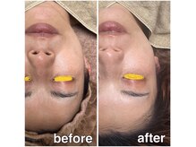 アンドナップ(nap)の雰囲気（産毛や余分な角質・角栓を除去し、美容成分導入し肌質改善！）