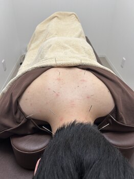 そよな はり灸整骨院/肩こりはお任せください!