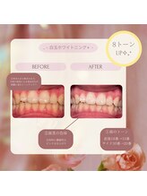 プラスビーセルフ(+b self)/ホワイトニングビフォーアフター