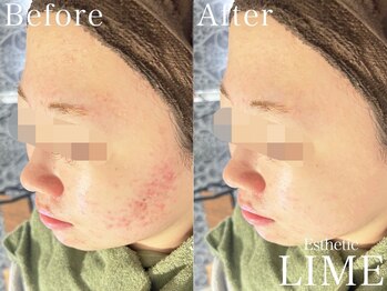 ベル 赤羽(Belle)/ハーブピーリング｜ニキビケア