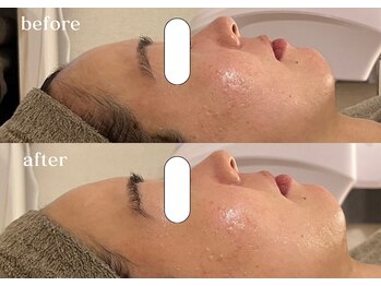 リスタ(RSTA)/【BEFORE/AFTER】