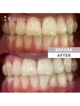 イージーホワイトニング 中野店(easy whitening)/セルフホワイトニング症例写真