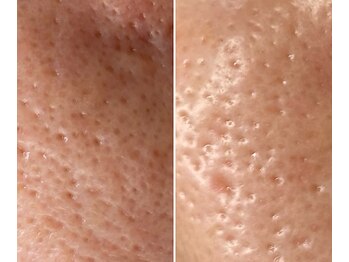 サイ(Sai)/before⇒after