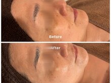 サロンアルーナ(Salon a Luna)/剥離しないハーブピーリング