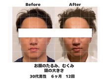 ラナン パラフューズ(Ranun's PARAFUSE.)/むくみが取れると小顔になる♪