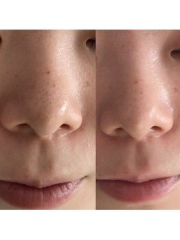 レオティアラ(REOTIARA)の写真/炭酸パックで毛穴ケアやエラスチン補給やコラーゲン補給やヒト幹細胞補給有名女優さんも使わせています