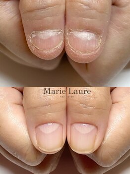 マリーロール 梅田店(Marie Laure)/自爪育成/深爪矯正/ネイルケア