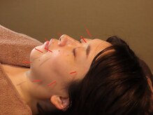 リ フリー 宮の森店(Re'free)/お肌の代謝に美容鍼