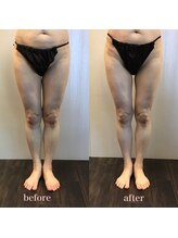 ラウレア 西条店(LAULEA)/ハイパーナイフ痩身before/after