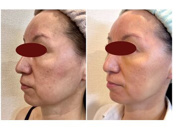 ルフレ(REFLET)/【事例1】Before/Afterたるみ