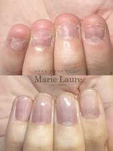 マリーロール 淀屋橋本店(Marie Laure)/自爪育成/深爪矯正/ネイルケア