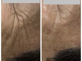 トータルビューティ リライフ(Total beauty Relife)/水素水ピーリングエクソソーム