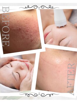 ピュアル 川口(Pual)/ニキビ/オイリー/赤ら顔/乾燥