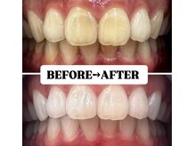 ホワイトニングサロン 豊中/Before&After美白ホワイトニング
