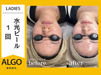 アルゴ 小松店(ALGO)/水光ピール（20代前半）