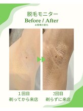 トッコ 清澄白河店(tocco)/ワキ脱毛