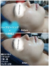 ベルクラージュ(Belle Courage)/20代　リフトアップ・浮腫み