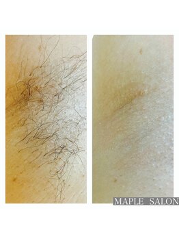 メープルサロン(MAPLE SALON)/脇シュガーリング
