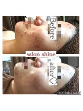 サロンシャイン(Salon Shine)/ハーバルピールレベル7