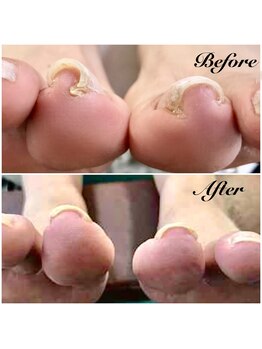 ノーラスリエン(Nolaslien)/巻き爪矯正