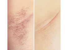 ルアナサロン(LUANA SALON)/両脇ワックス
