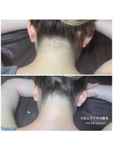 ピークハント(Peak Hunt)/うなじワックス脱毛