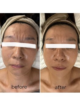 アンベリール(Embellir)/ララピール２回目施術後