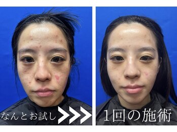 グリッター(GLITTER)