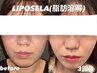 大人気♪お得すぎ【脂肪撃退】二重顎.むっちり頬解消/22000円→11500円