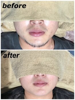 サヴァージュ(Sauvage)/髭脱毛 10回 before／after